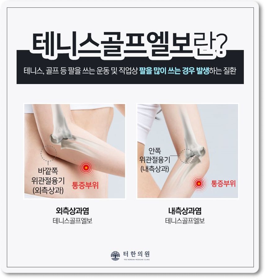 테니스골프엘보 통증 부위를 설명한 안내문