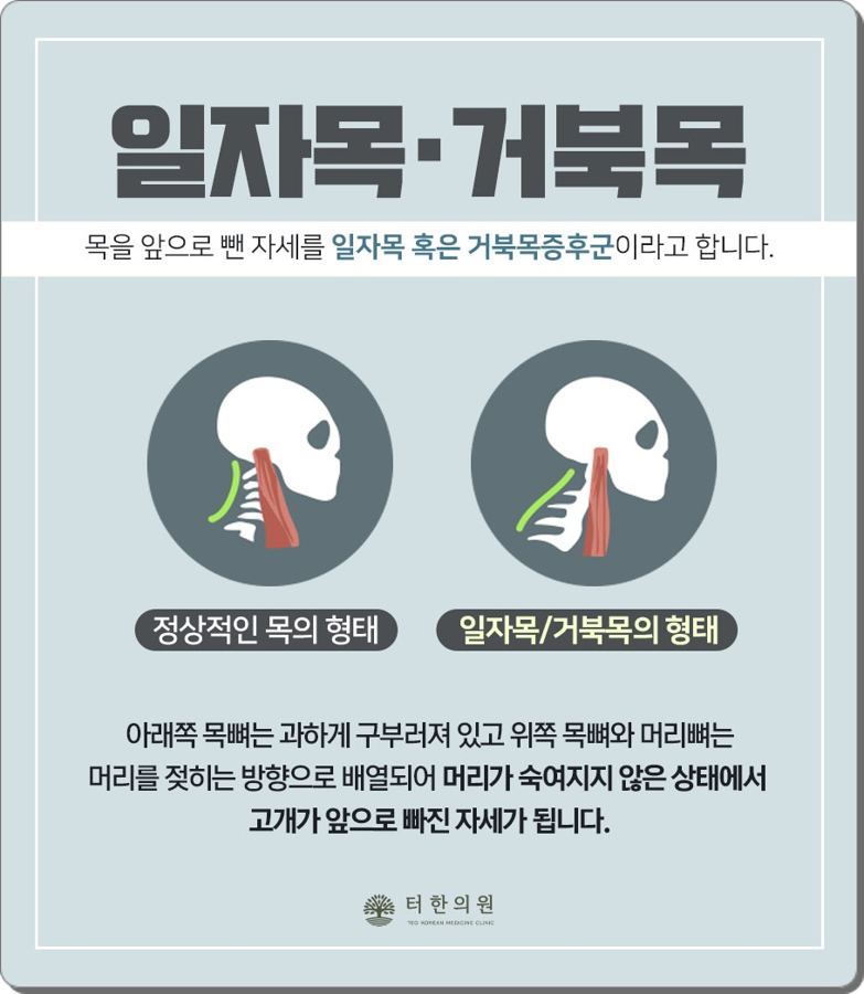 정상적인 목과 일자목의 형태를 비교 설명한 인체 그림
